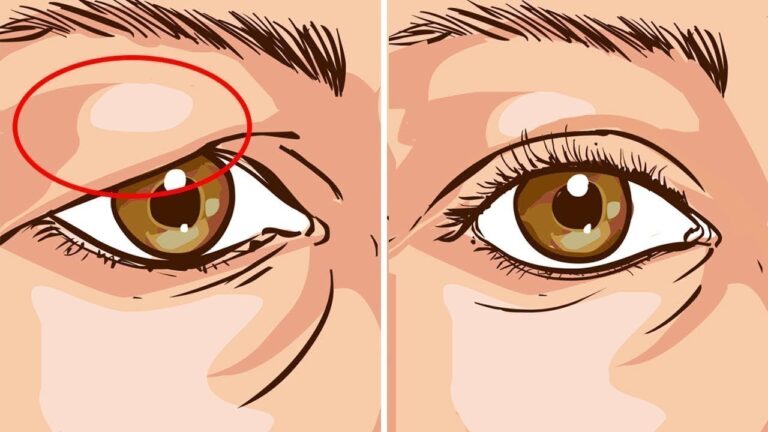 5 effektive Tipps zur natürlichen Behandlung von Schlupflidern entdecken!