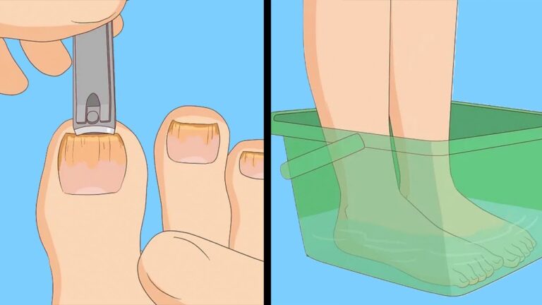 5 einfache Tipps gegen Nagelpilz – So wirst du ihn täglich los!
