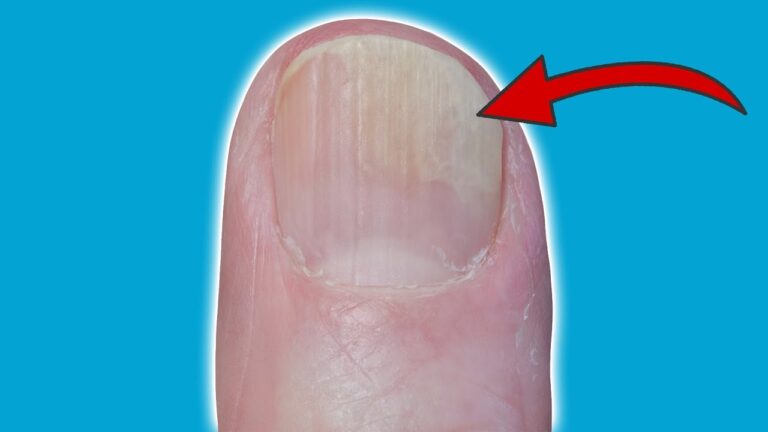 5 Hausmittel gegen Nagelprobleme, die du sofort ausprobieren kannst!